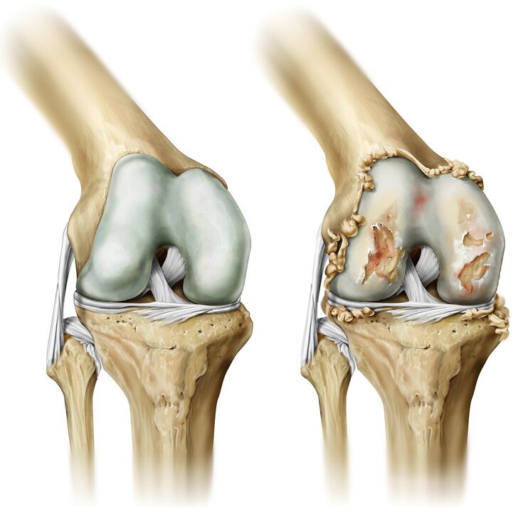 zglobovi uništeni artritisom