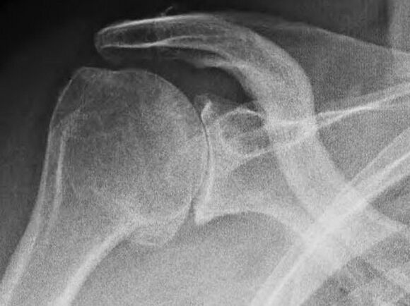 Rendgenski snimak ramenog zgloba zahvaćenog artrozom