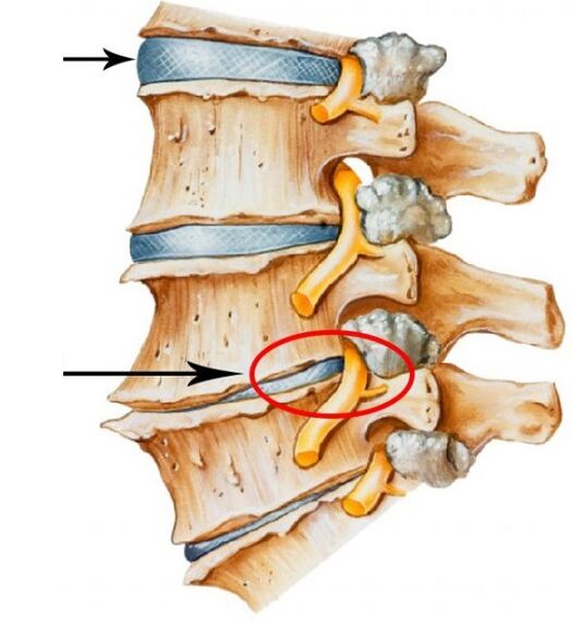 Cervikalna osteohondroza