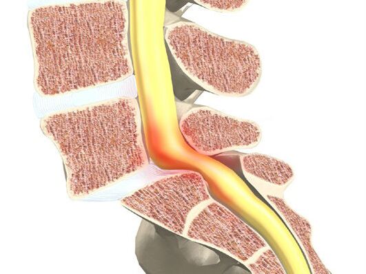 Segment krvi motora za osteohondrozu
