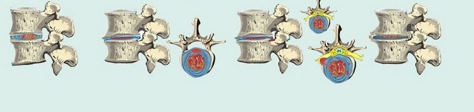 Razne faze torakalne osteohondroze