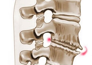 oštećenje pršljenova kod torakalne osteohondroze