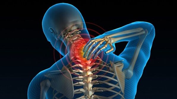 Bol pri okretanju vrata može ukazivati ​​na sindrom vertebralne cervikalne osteohondroze